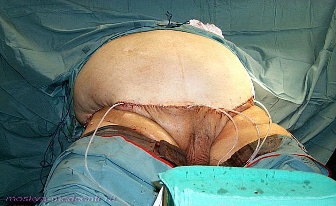 Ужасы медицины - пластическая хирургия. Липосакция живота - фото после операции.